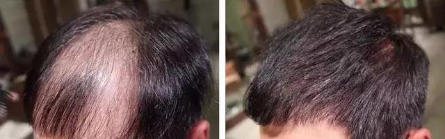 男生发际线高，头发稀少，剪这些发型就对了！