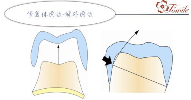牙齿缺损修复方法_牙齿缺损修复方法有哪些_牙齿缺损修复方法视频