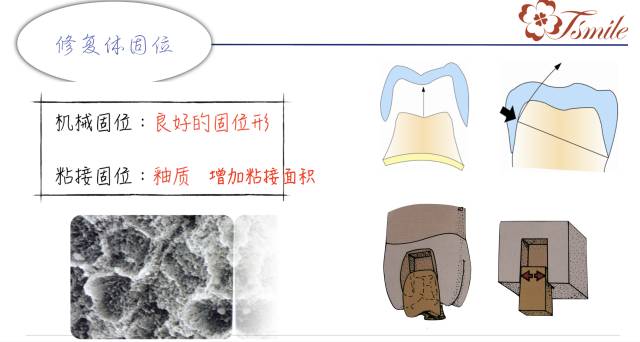 牙齿缺损修复方法_牙齿缺损修复方法有哪些_牙齿缺损修复方法视频