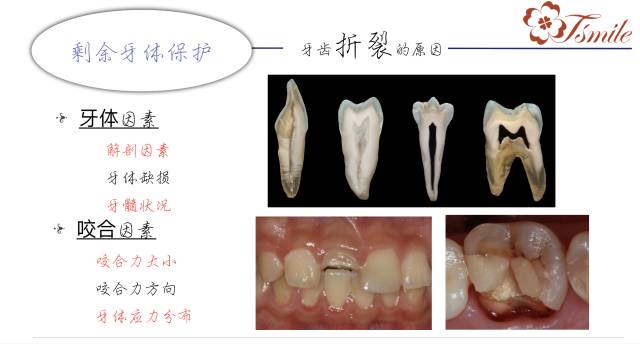 牙齿缺损修复方法有哪些_牙齿缺损修复方法_牙齿缺损修复方法视频