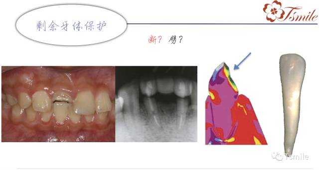 牙齿缺损修复方法有哪些_牙齿缺损修复方法视频_牙齿缺损修复方法