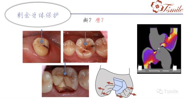 牙齿缺损修复方法有哪些_牙齿缺损修复方法视频_牙齿缺损修复方法