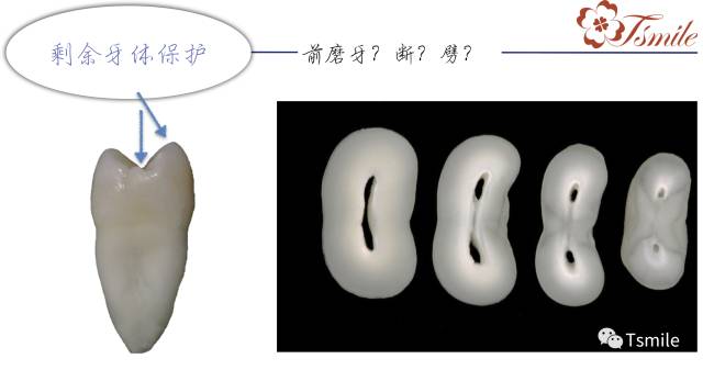 牙齿缺损修复方法有哪些_牙齿缺损修复方法视频_牙齿缺损修复方法