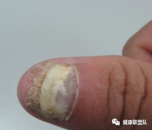 土法治疗灰指甲办法有哪些_土方甲治疗法灰指甲怎么治_土方法治疗灰指甲