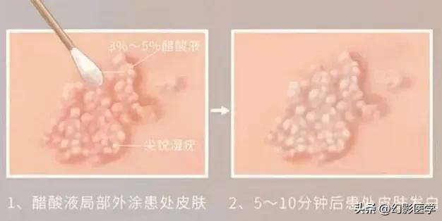 女生珍珠状丘疹_女性珍珠状丘疹_女性珍珠样丘疹