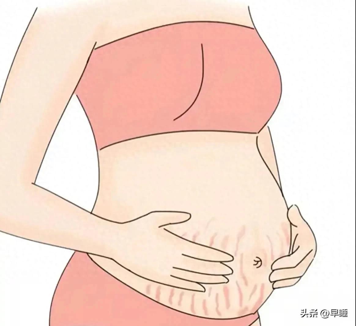 怀孕期间长妊娠纹_孕期几个月长妊娠纹_孕妇长妊娠纹
