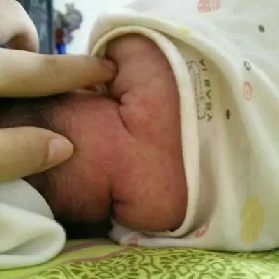 孕妇胎毒一般长在哪里_孕妇胎毒是什么样子_孕妈胎毒