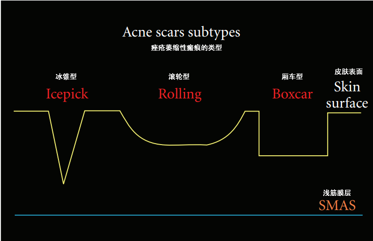 祛痘坑效果最好的方法_祛痘坑最好的方法_祛痘坑效果对比图