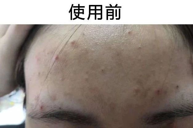 祛痘坑最新技术_祛痘坑效果最好的方法_祛痘坑最好的方法