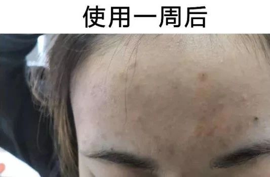 祛痘坑最新技术_祛痘坑效果最好的方法_祛痘坑最好的方法