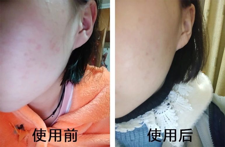 祛痘坑最好的方法_祛痘坑最新技术_祛痘坑效果最好的方法