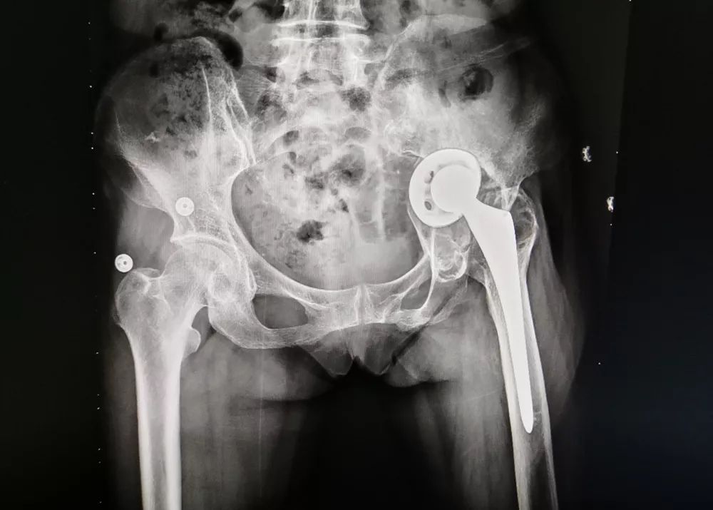 人工髋关节翻修最新技术_人工全髋关节翻修技术_人工髋关节翻修手术学