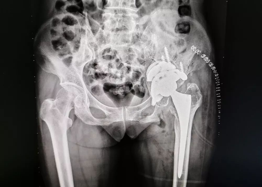 人工全髋关节翻修技术_人工髋关节翻修最新技术_人工髋关节翻修手术学