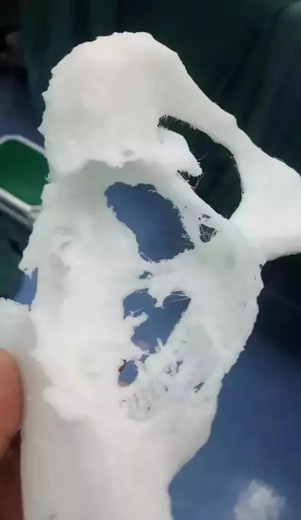 人工全髋关节翻修技术_人工髋关节翻修手术学_人工髋关节翻修最新技术