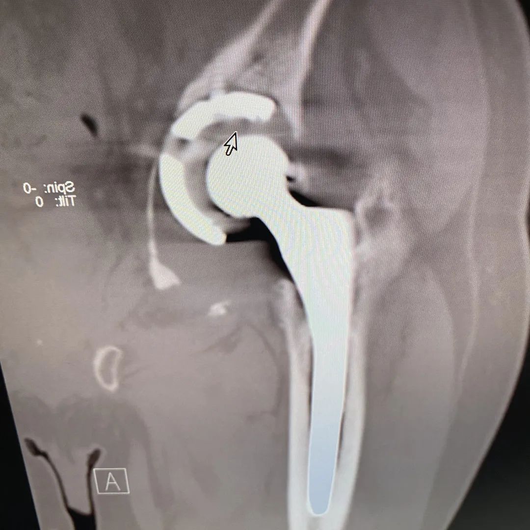 人工全髋关节翻修术费用_人工全髋关节翻修技术_人工髋关节翻修术翻修原则