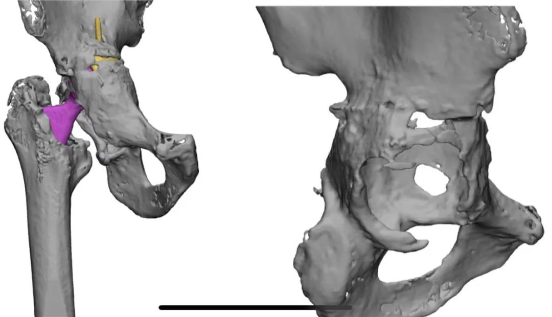 人工全髋关节翻修术费用_人工髋关节翻修术翻修原则_人工全髋关节翻修技术