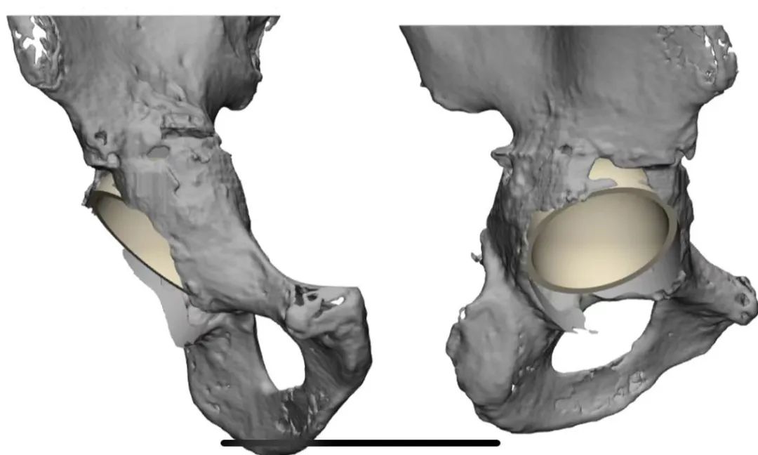 人工全髋关节翻修术费用_人工全髋关节翻修技术_人工髋关节翻修术翻修原则