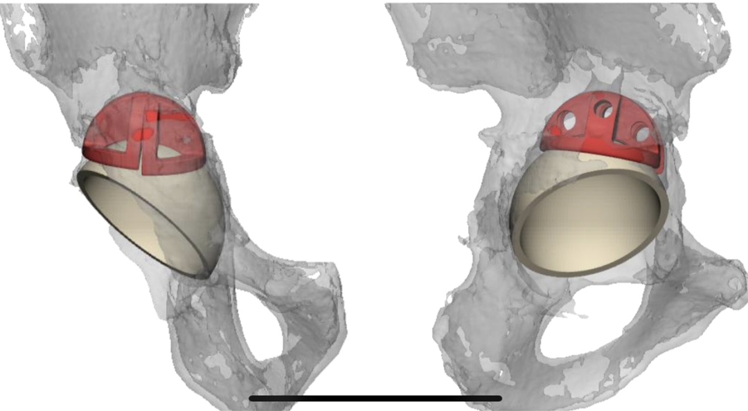 人工全髋关节翻修术费用_人工髋关节翻修术翻修原则_人工全髋关节翻修技术