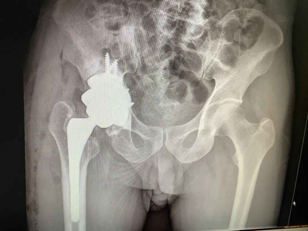 人工全髋关节翻修术费用_人工髋关节翻修术翻修原则_人工全髋关节翻修技术