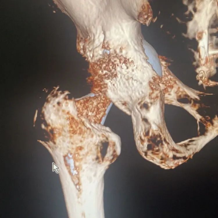 人工髋关节翻修术翻修原则_人工全髋关节翻修技术_人工全髋关节翻修术费用