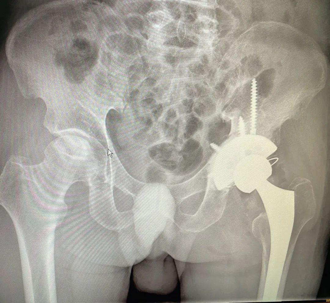 人工全髋关节翻修技术_人工全髋关节翻修术费用_人工髋关节翻修术翻修原则