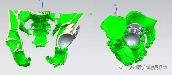 人工全髋关节翻修技术_人工全髋关节翻修术费用_人工髋关节翻修术复杂吗