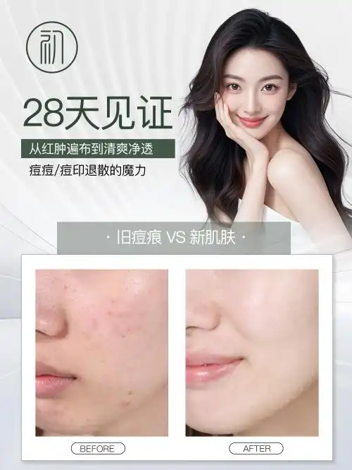 专业的祛痘方法_祛痘膏推荐_初源漾专研净痘啫喱好用吗