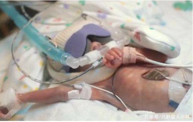 32周出生进保温箱费用_早产儿保温箱费用_早产儿重症监护病房