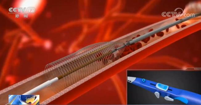 冠脉支架带量采购中选产品价格_国家组织冠脉支架集中招标采购_医疗器械招标价