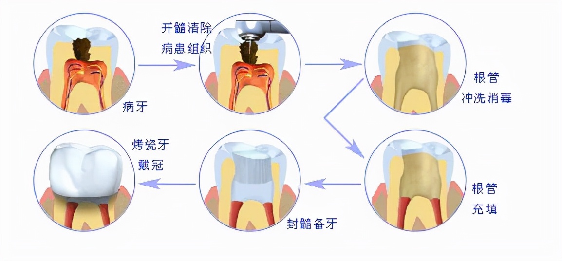 根管治疗后镶牙_牙科烤瓷牙价钱_烤瓷牙修复