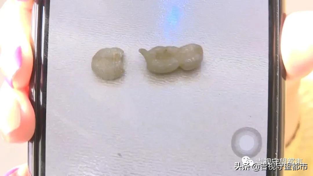 牙科烤瓷牙价钱_烤瓷牙维修费用_烤瓷牙质量问题处理