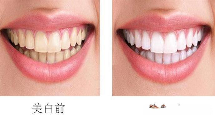 想让牙齿变白变美,快来看看吧(图2) 牙齿美白方法_洗牙牙齿美容_成都牙齿变黄美白技术