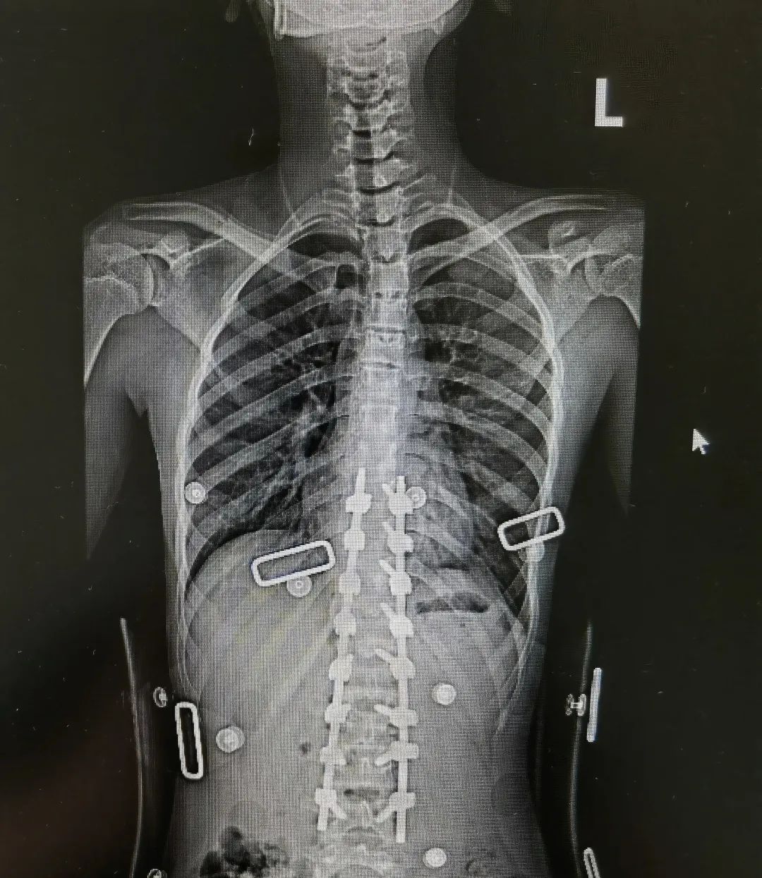 青少年特发性脊柱侧弯 手术治疗 先天性脊柱侧弯_脊柱侧弯吧断棒翻修