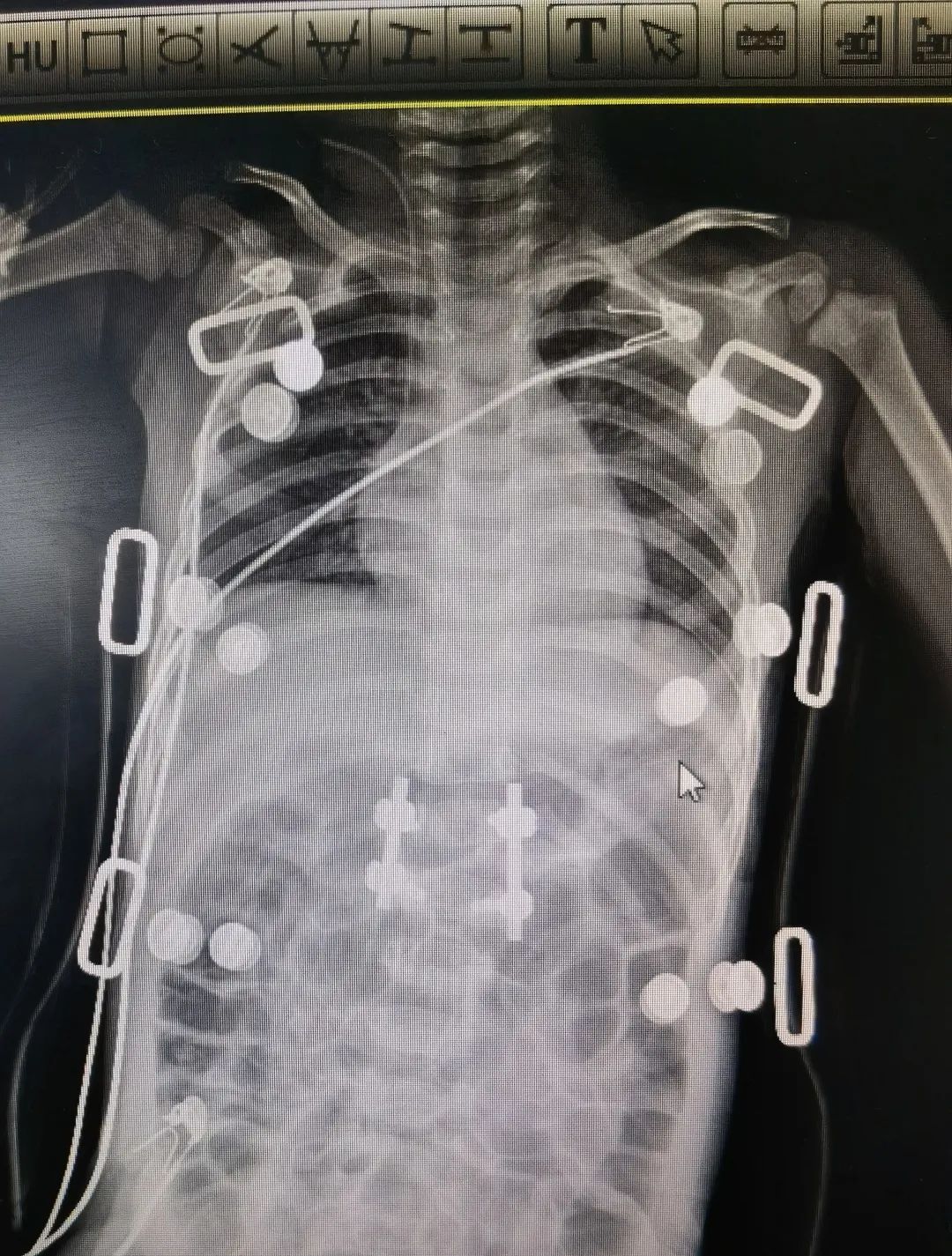 脊柱侧弯吧断棒翻修_青少年特发性脊柱侧弯 手术治疗 先天性脊柱侧弯