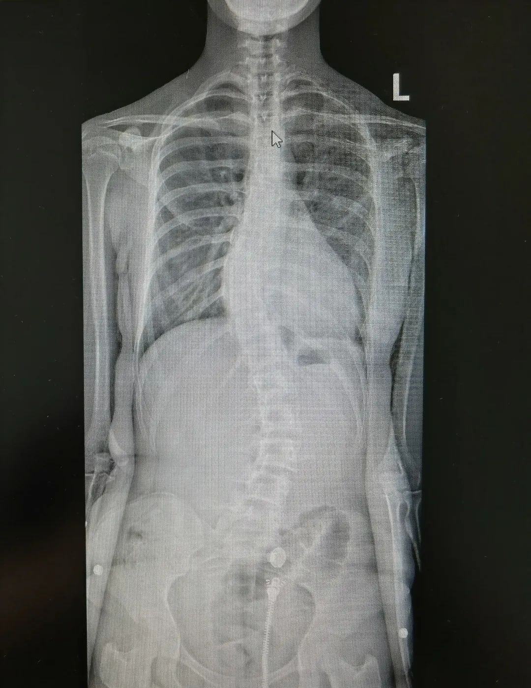 脊柱侧弯吧断棒翻修_青少年特发性脊柱侧弯 手术治疗 先天性脊柱侧弯