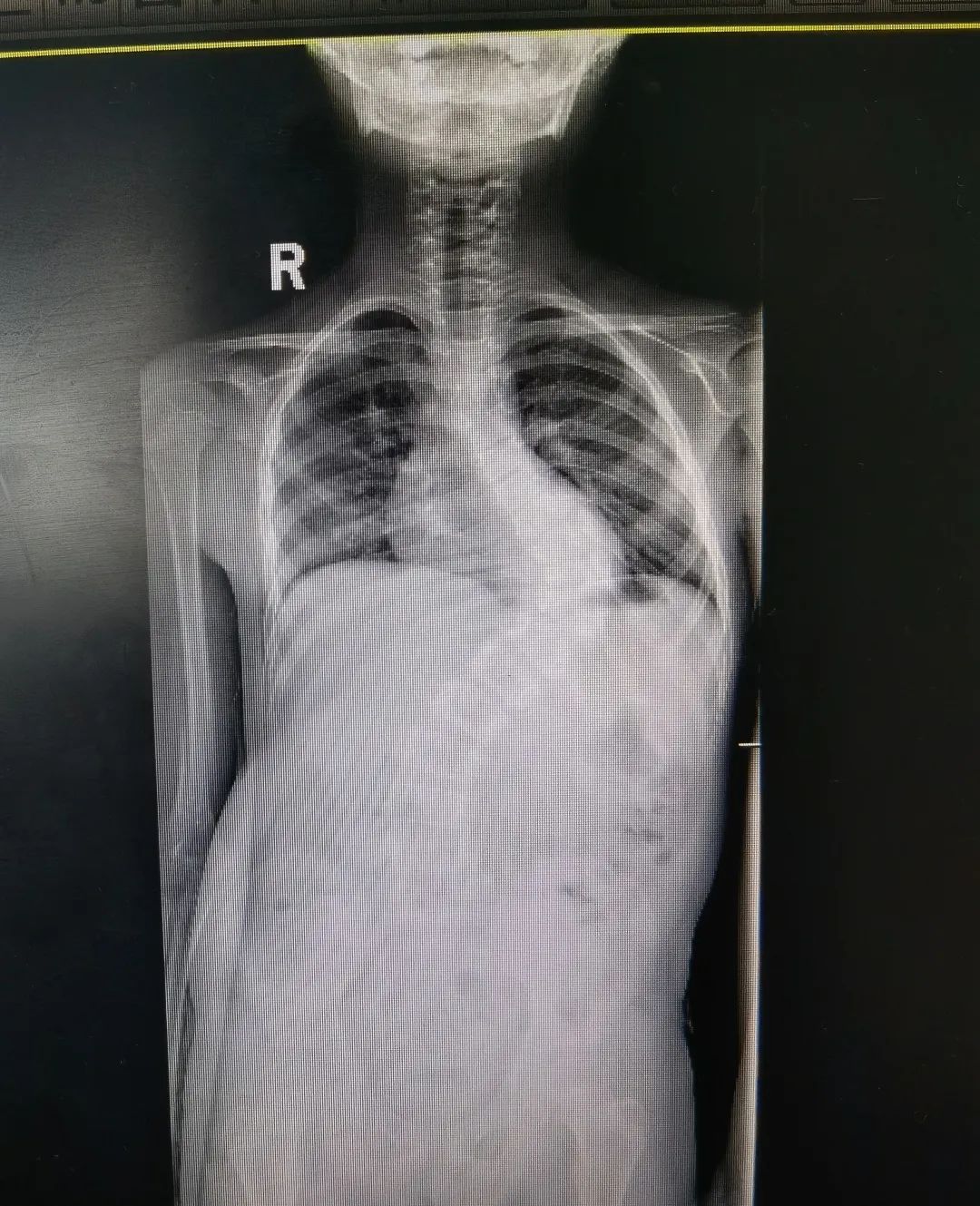 脊柱侧弯吧断棒翻修_青少年特发性脊柱侧弯 手术治疗 先天性脊柱侧弯