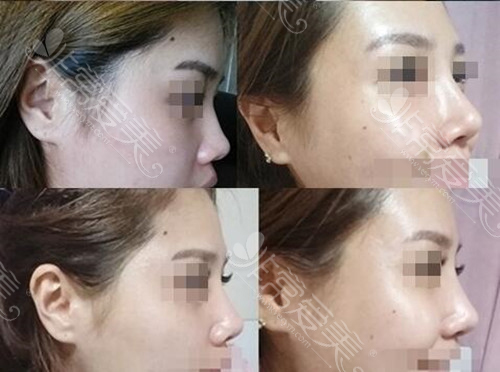 韩国cowell整形外科鼻整形日记图