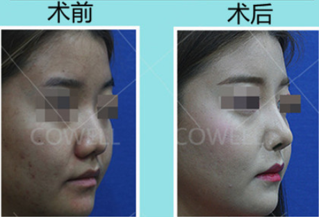 隆鼻前后对比图