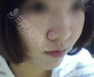 假体取出后鼻部形态照