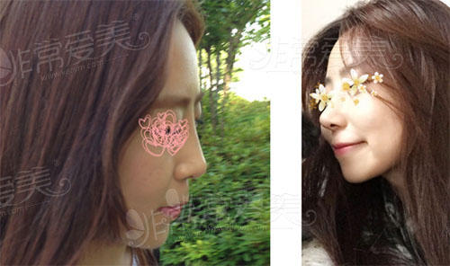 cowell医院姜昌均隆鼻修复手术日记