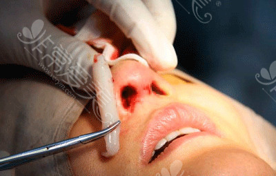 隆鼻假体取出后照片