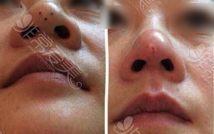 埋线隆鼻鼻尖凹陷照片