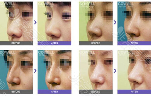 韩国cowell整形医院鼻日记集合