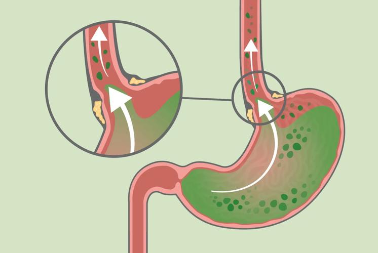 喉咙的这几个表现,别以为是感冒,或是癌症的信号,一定要注意了(图9) 喉咙异物感持续两周以上_嗓子反复疼痛怎么回事_声音嘶哑超过两周未愈