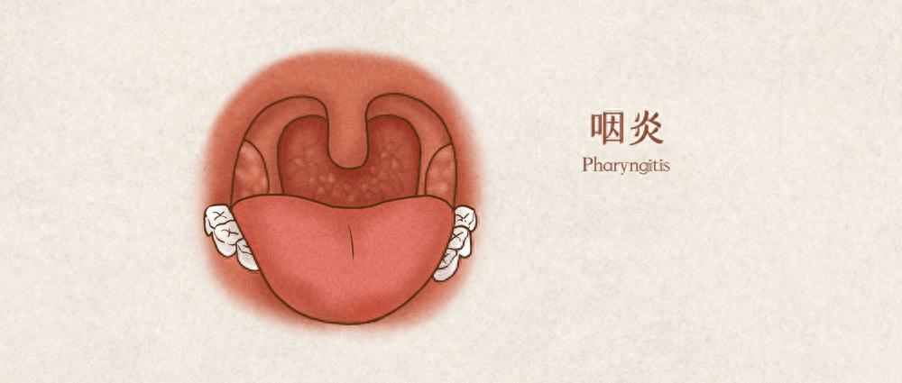 喉咙干痒有异物感,咳不出又咽不下?小心是慢性咽炎在作祟!(图1) 慢性咽炎诱发因素_慢性咽炎症状_嗓子反复疼痛怎么回事